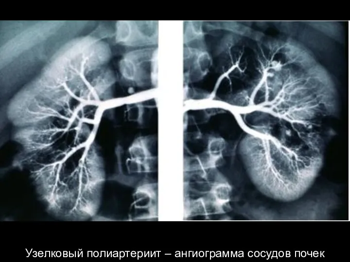 Узелковый полиартериит – ангиограмма сосудов почек