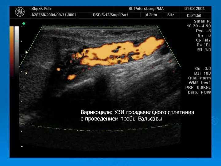 Варикоцеле: УЗИ гроздьевидного сплетения с проведением пробы Вальсавы