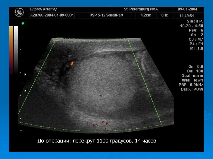 До операции: перекрут 1100 градусов, 14 часов