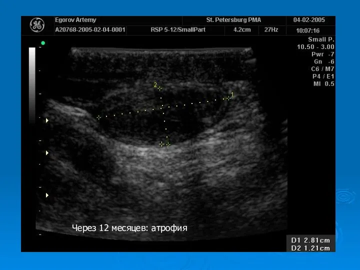 Через 12 месяцев: атрофия