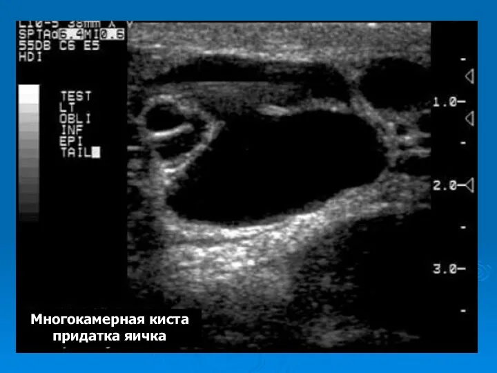 Многокамерная киста придатка яичка