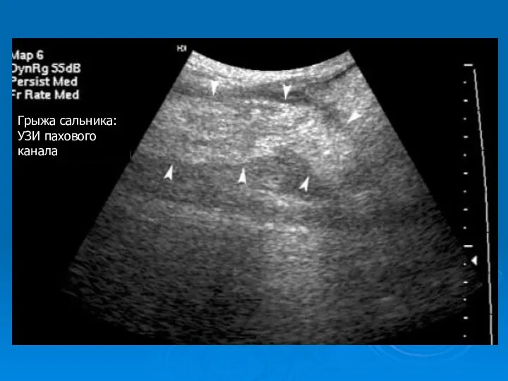 Грыжа сальника: УЗИ пахового канала