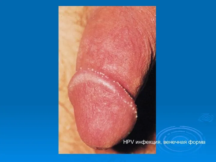 HPV инфекция, венечная форма