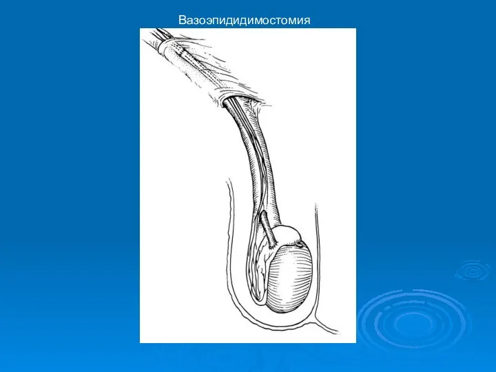 Вазоэпидидимостомия
