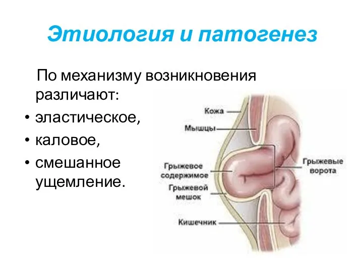 Этиология и патогенез По механизму возникновения различают: эластическое, каловое, смешанное ущемление.