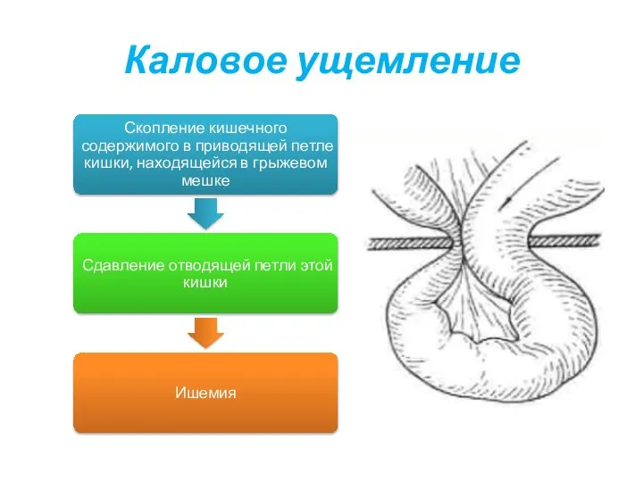 Каловое ущемление