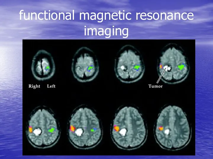 functional magnetic resonance imaging
