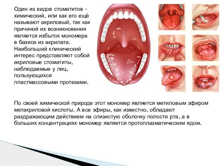Один из видов стоматитов – химический, или как его ещё называют акриловый,