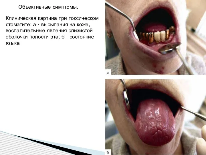 Клиническая картина при токсическом стоматите: а - высыпания на коже, воспалительные явления