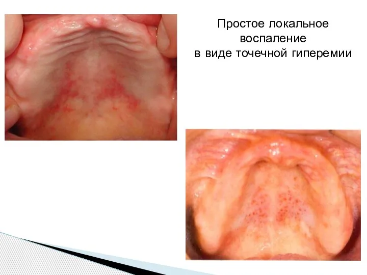 Простое локальное воспаление в виде точечной гиперемии