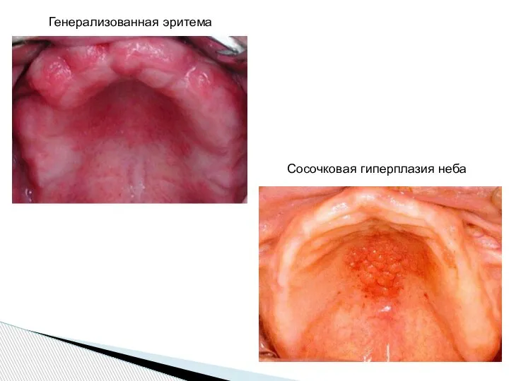 Генерализованная эритема Сосочковая гиперплазия неба