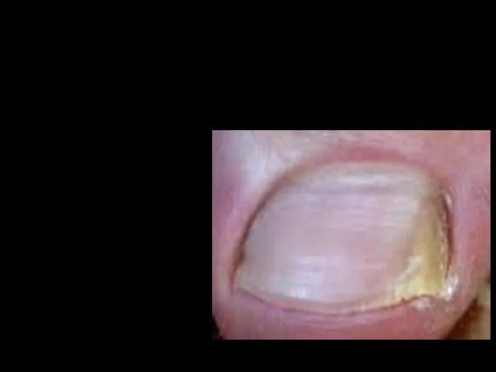 Онихомикоз - поражение ногтей грибковой инфекцией. Заболевание встречается у 5-10% населения и