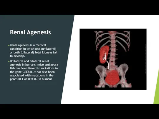 Renal Agenesis Renal agenesis is a medical condition in which one (unilateral)
