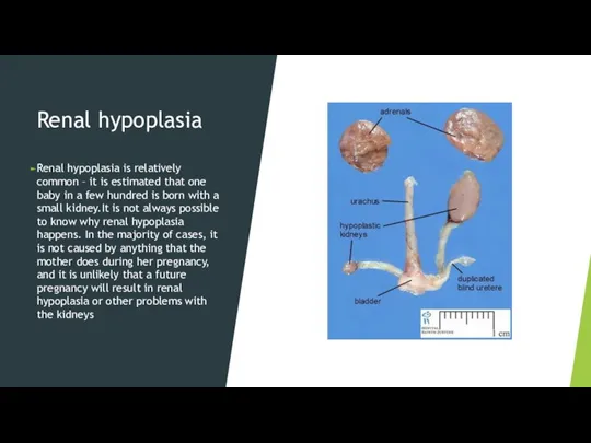 Renal hypoplasia Renal hypoplasia is relatively common – it is estimated that