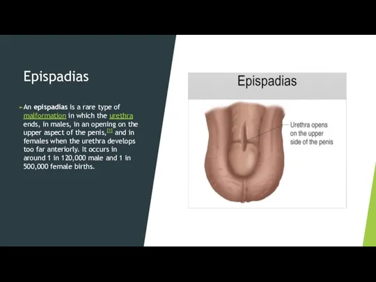 Epispadias An epispadias is a rare type of malformation in which the