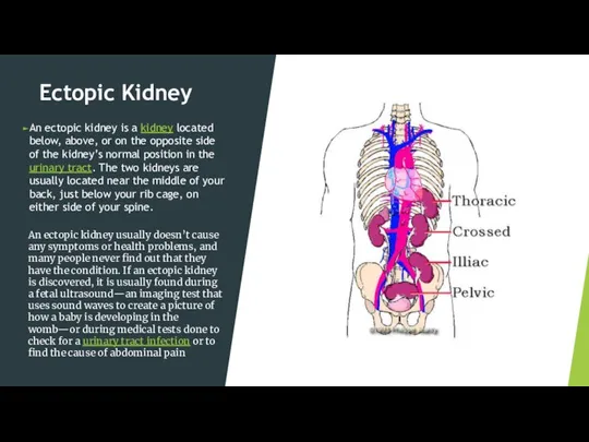 Ectopic Kidney An ectopic kidney is a kidney located below, above, or