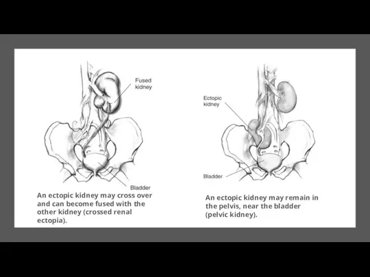 An ectopic kidney may remain in the pelvis, near the bladder (pelvic