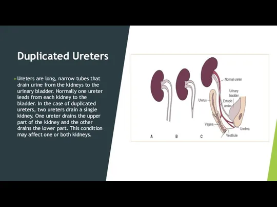 Duplicated Ureters Ureters are long, narrow tubes that drain urine from the