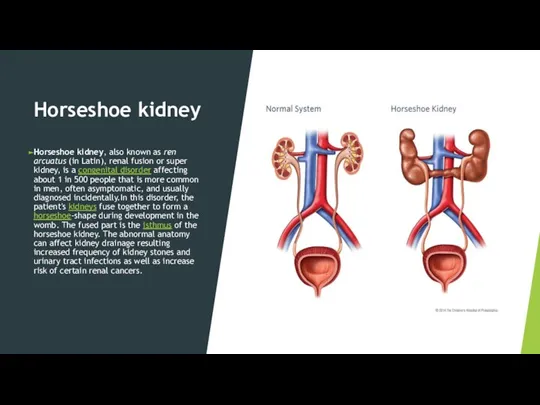 Horseshoe kidney Horseshoe kidney, also known as ren arcuatus (in Latin), renal