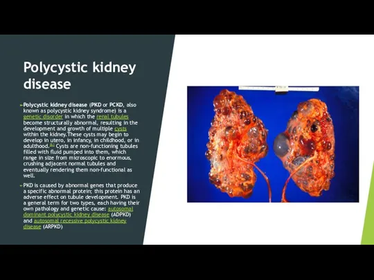 Polycystic kidney disease Polycystic kidney disease (PKD or PCKD, also known as
