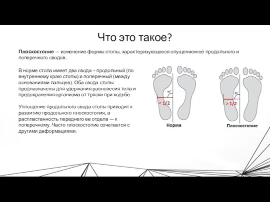 Плоскостопие — изменение формы стопы, характеризующееся опущением её продольного и поперечного сводов.