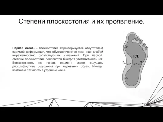 Степени плоскостопия и их проявление. Первая степень плоскостопия характеризуется отсутствием видимой деформации,