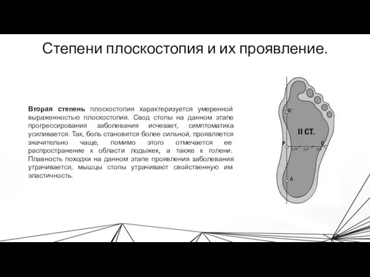 Степени плоскостопия и их проявление. Вторая степень плоскостопия характеризуется умеренной выраженностью плоскостопия.