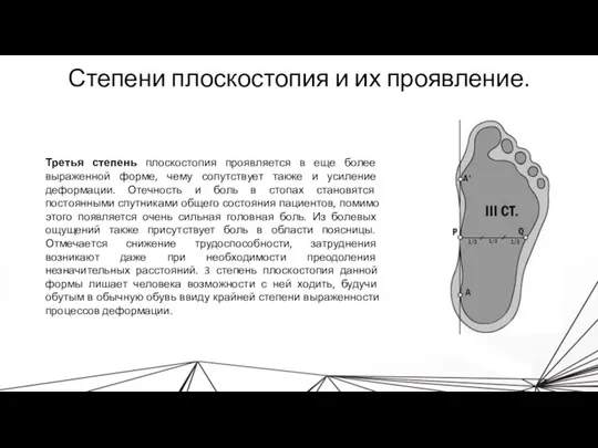 Степени плоскостопия и их проявление. Третья степень плоскостопия проявляется в еще более