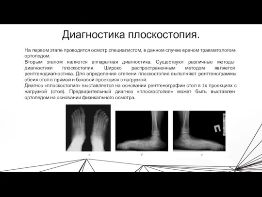 Диагностика плоскостопия. На первом этапе проводится осмотр специалистом, в данном случае врачом