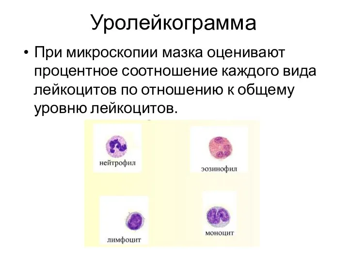 Уролейкограмма При микроскопии мазка оценивают процентное соотношение каждого вида лейкоцитов по отношению к общему уровню лейкоцитов.