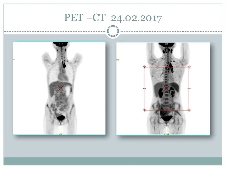 PET –CT 24.02.2017