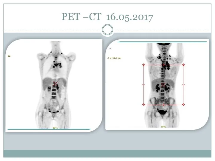 PET –CT 16.05.2017