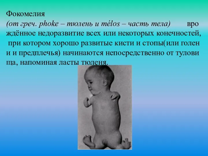 Фокомелия(от греч. phoke – тюлень и mélos – часть тела) врождённое недоразвитие