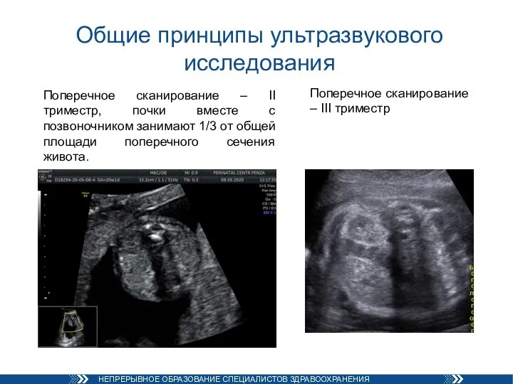 Общие принципы ультразвукового исследования Поперечное сканирование – II триместр, почки вместе с