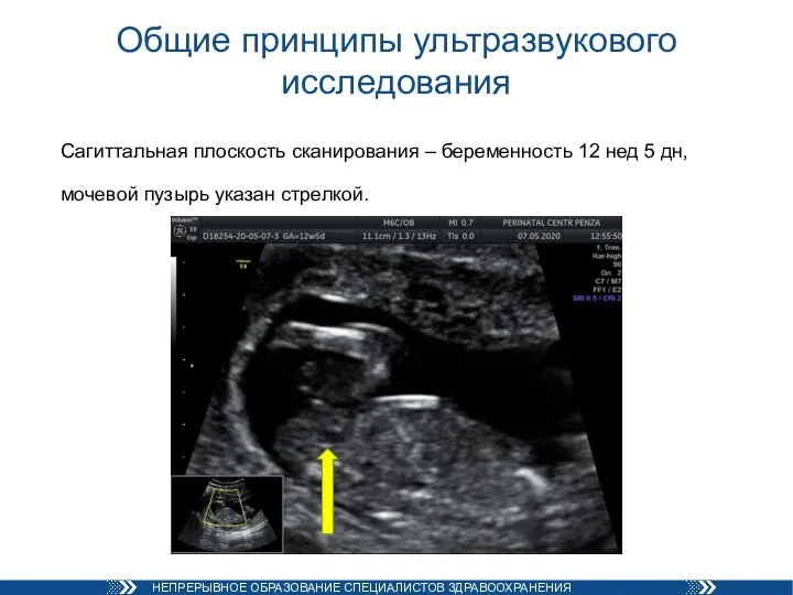 Общие принципы ультразвукового исследования Сагиттальная плоскость сканирования – беременность 12 нед 5
