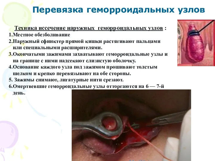 Перевязка геморроидальных узлов Техника иссечение наружных геморроидальных узлов : Местное обезболивание Наружный