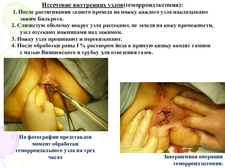 Иссечение внутренних узлов(геморроидэктомия): 1. После растягивания заднего прохода на ножку каждого узла