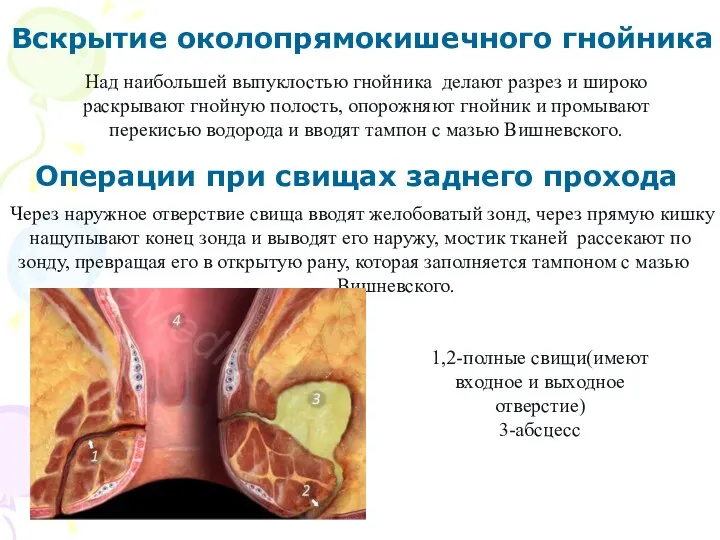 Вскрытие околопрямокишечного гнойника Операции при свищах заднего прохода Над наибольшей выпуклостью гнойника