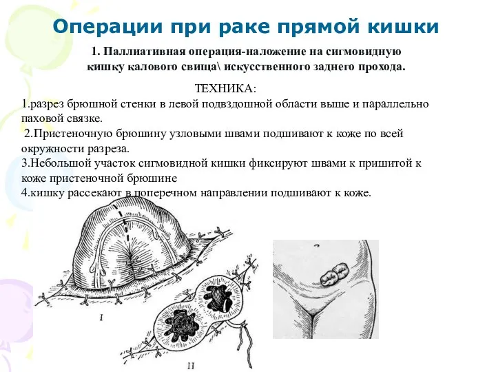 ТЕХНИКА: 1.разрез брюшной стенки в левой подвздошной области выше и параллельно паховой