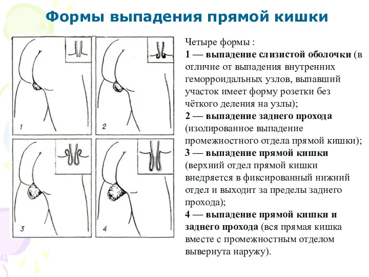 Формы выпадения прямой кишки Четыре формы : 1 — выпадение слизистой оболочки