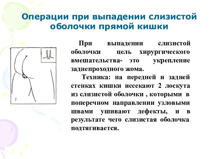 При выпадении слизистой оболочки цель хирургического вмешательства- это укрепление заднепроходного жома. Техника: