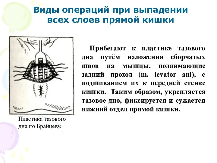 Виды операций при выпадении всех слоев прямой кишки Прибегают к пластике тазового