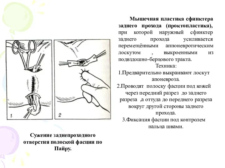 Мышечная пластика сфинктера заднего прохода (проктопластика), при которой наружный сфинктер заднего прохода