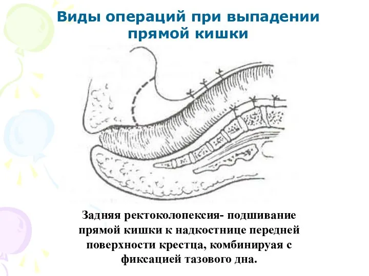 Виды операций при выпадении прямой кишки Задняя ректоколопексия- подшивание прямой кишки к