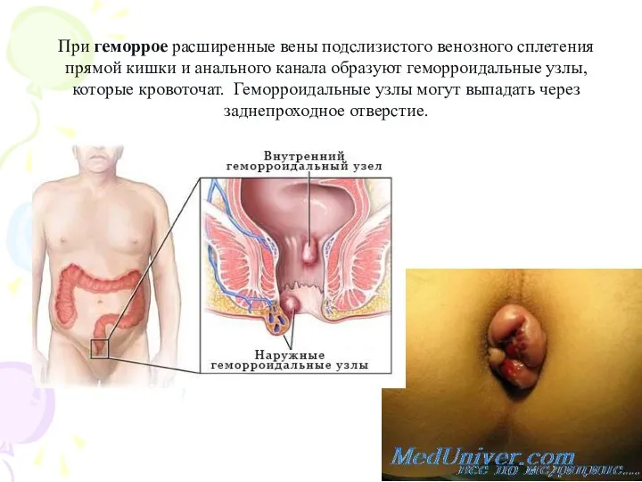 При геморрое расширенные вены подслизистого венозного сплетения прямой кишки и анального канала