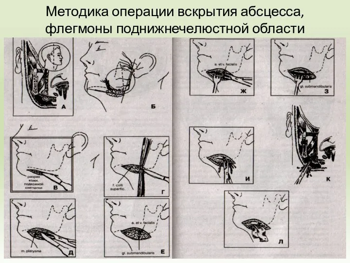 Методика операции вскрытия абсцесса, флегмоны поднижнечелюстной области