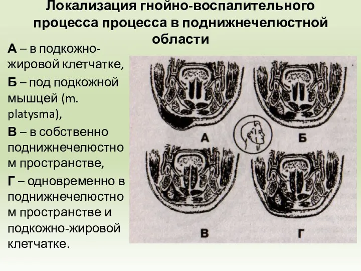 Локализация гнойно-воспалительного процесса процесса в поднижнечелюстной области А – в подкожно-жировой клетчатке,