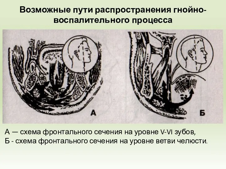 Возможные пути распространения гнойно-воспалительного процесса А — схема фронтального сечения на уровне