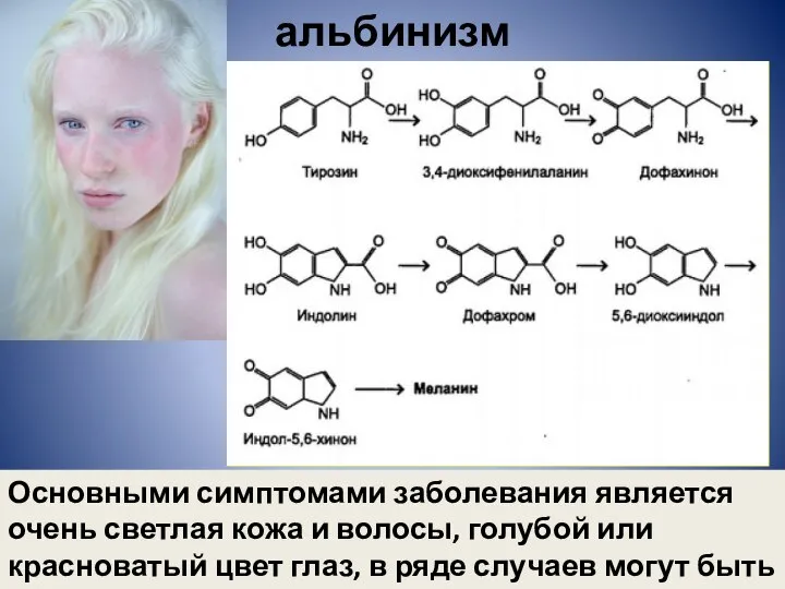 альбинизм Основными симптомами заболевания является очень светлая кожа и волосы, голубой или