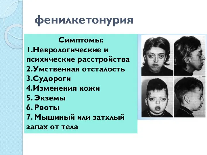 фенилкетонурия Симптомы: 1.Неврологические и психические расстройства 2.Умственная отсталость 3.Судороги 4.Изменения кожи 5.